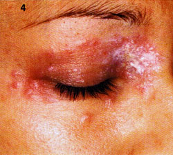 Herpes-Bläschen rund um das rechte Auge einer Patientin