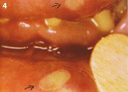 Weiße Bläschen im Mund eines Patienten