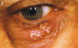 Weiße Bläschen unter dem rechten Auge eines Patienten