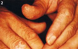 nahaufnahme von Hautveränderungen an den Fingerkuppen eines Patienten