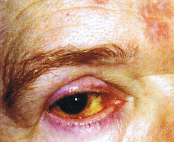 Entzündetes Augenlid und gelblich verfärbter Augapfel einer älteren Patientin